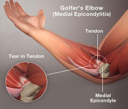 Golf-Elbow-Medial-Epicondylitis-Treatment-Doctor-Specialist-NYC.jpg